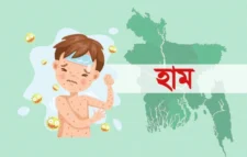 হাম ও উপসর্গ নিয়ে আরও পাঁচ শিশুর মৃত্যু