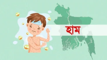 হাম ও উপসর্গ নিয়ে আরও পাঁচ শিশুর মৃত্যু