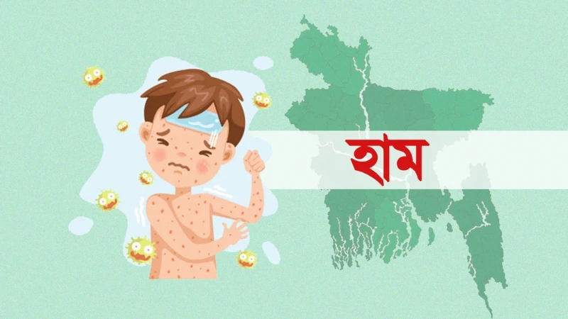 হাম ও উপসর্গ নিয়ে আরও পাঁচ শিশুর মৃত্যু